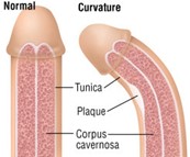 Dr. Peinado: “El mito clásico de que ‘un tercio con Enfermedad de Peyronie mejora espontáneamente’ está hoy descartado”